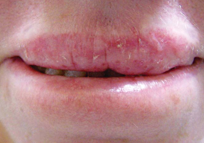 ACTINIC CHEILITIS - Cacherbal | Ayurvedic Treatment