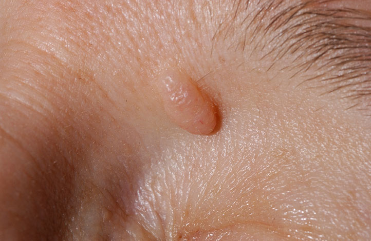 DERMAL NEVUS