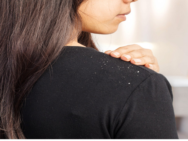 5 HOME REMEDIES TO GET RID OF DANDRUFF