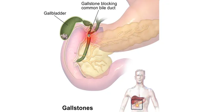 gallbladder disease