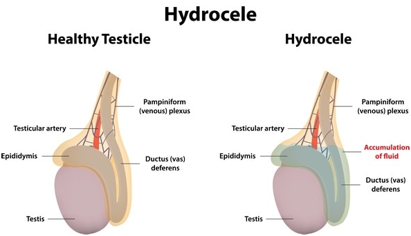 hydrocele