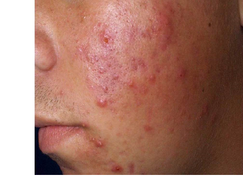 How to get rid of red blemishes on face naturally