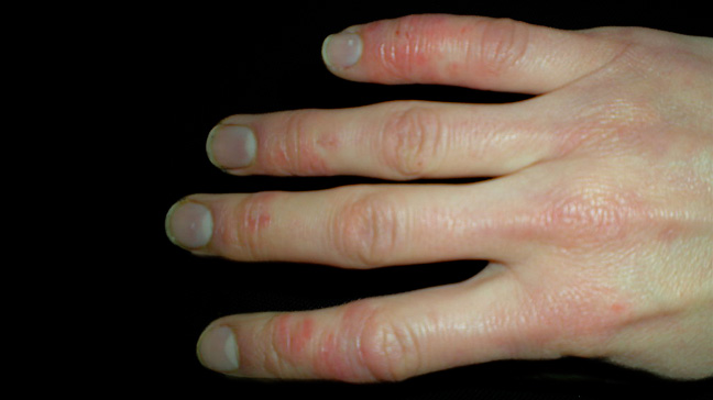 Scleroderma