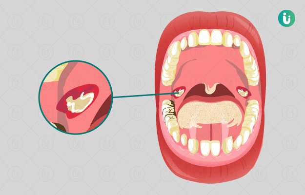 diphtheria