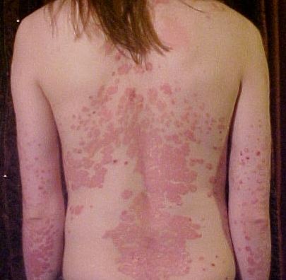 HOME REMEDIES FOR PSORIASIS