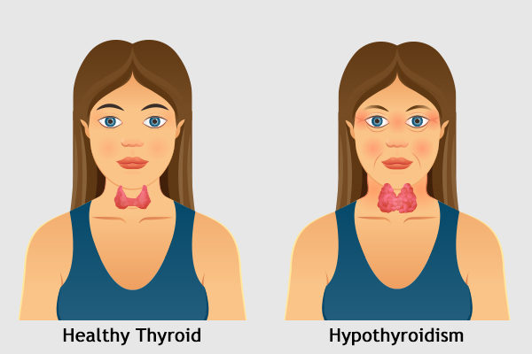 hypothyroidism