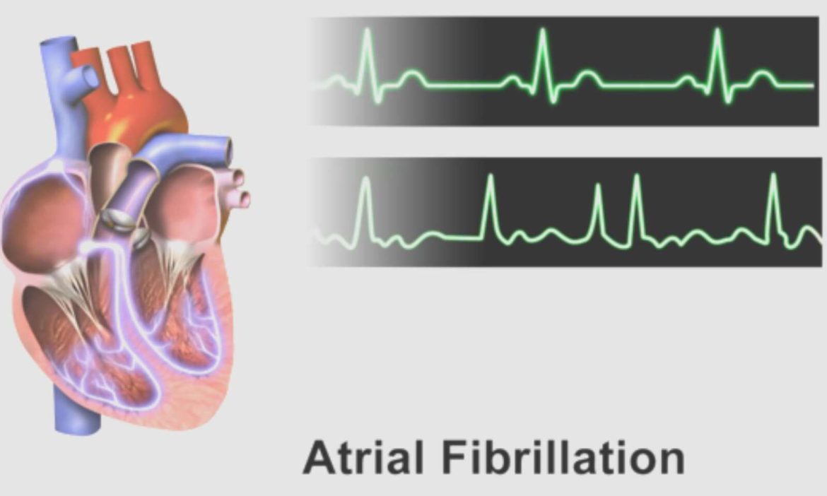 atrial-fibrillation