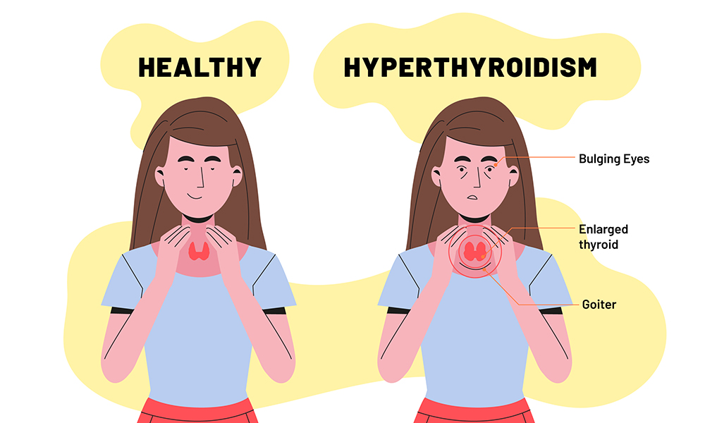 Hyperthyroidism