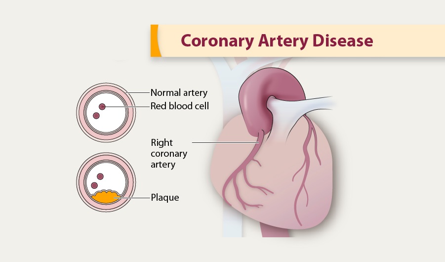 coronary-artery-disease