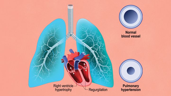 pulmonary-artery-hypertension